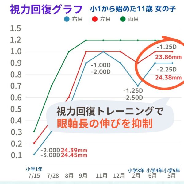 眼軸長でも視力回復